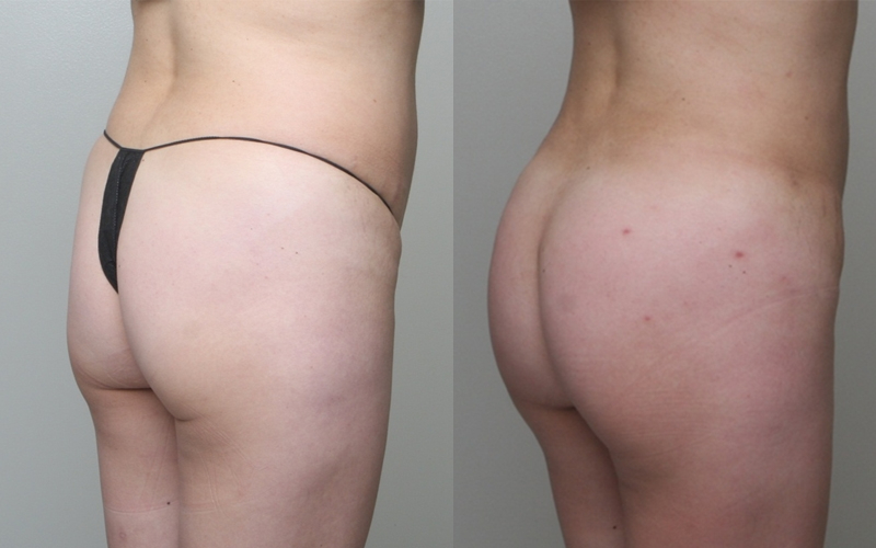 Before and After Image: Patient 3 - back