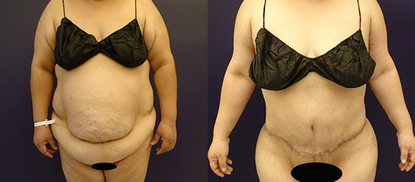 Before and After Image: Patient 1 - front