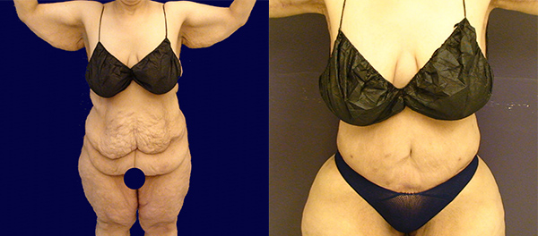 Before and After Image: Patient 2 - front