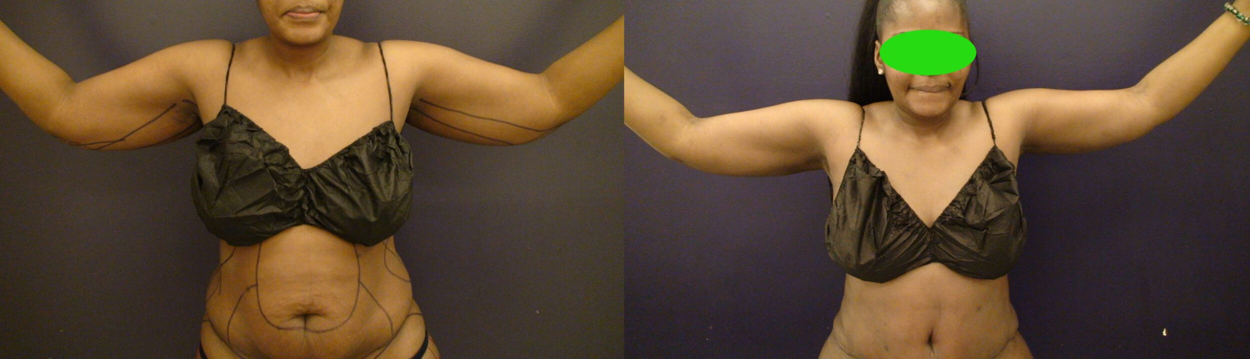 Before and After Image: Patient 1 - front