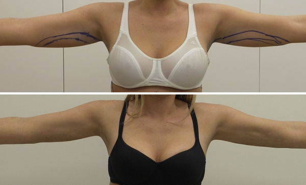 Before and After Image: Patient 1 - front