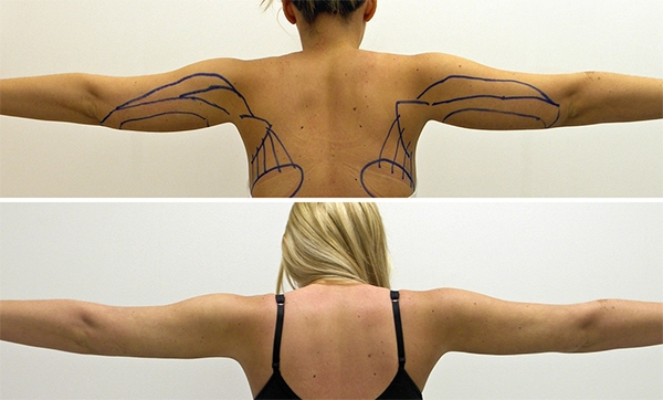 Before and After Image: Patient 1 - back