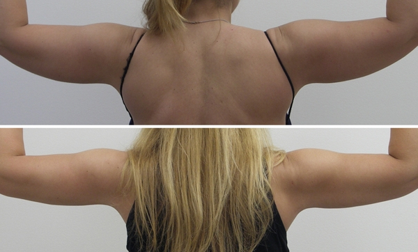 Before and After Image: Patient 2 - back