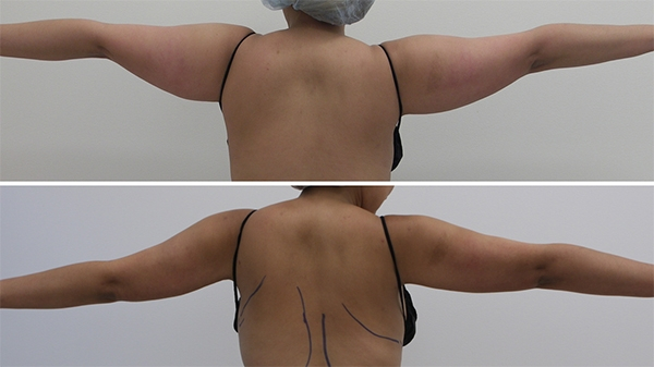 Before and After Image: Patient 3 - back