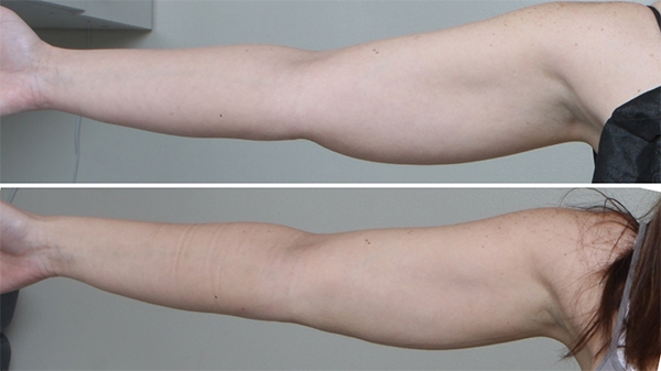 Before and After Image: Patient 4 - front