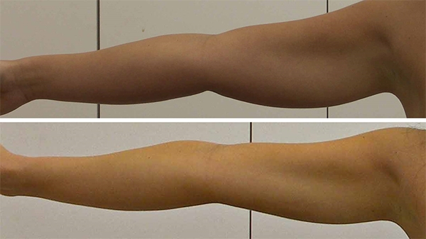 Before and After Image: Patient 5 - front