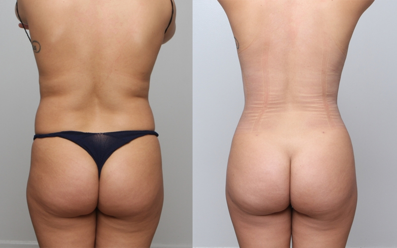 Before and After Image: Patient 1 - back