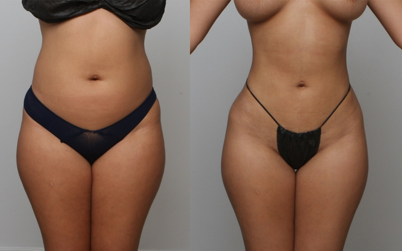 Before and After Image: Patient 2 - front
