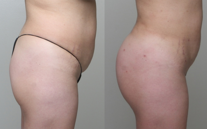 Before and After Image: Patient 3 - right-side