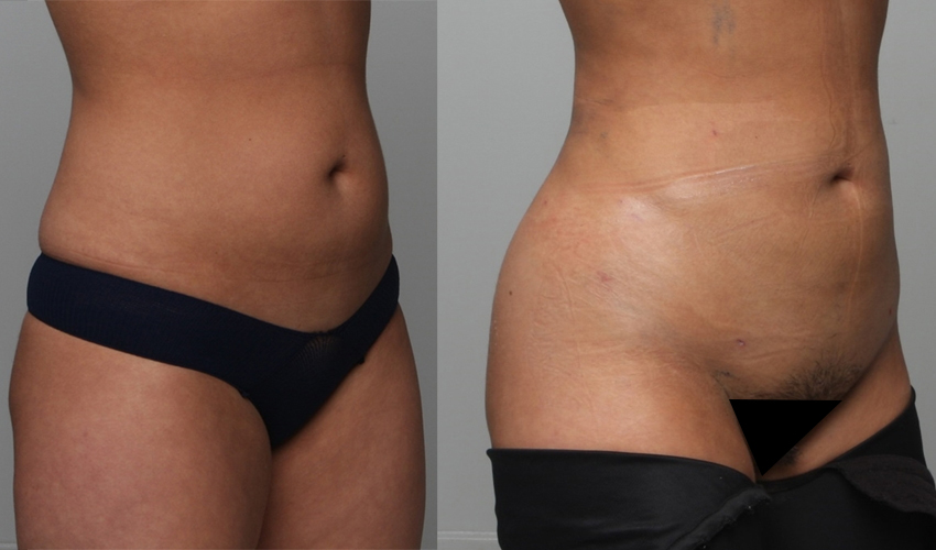 Before and After Image: Patient 4 - right-front-oblique