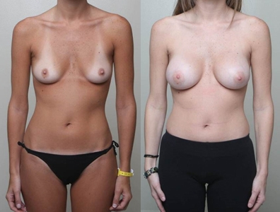 Before and After Image: Patient 1 - front