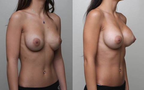 Before and After Image: Patient 10 - right-front-oblique