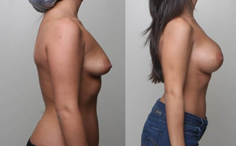 Before and After Image: Patient 11 - right-side