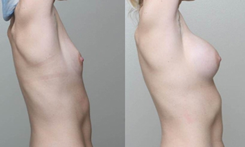 Before and After Image: Patient 2 - right-side