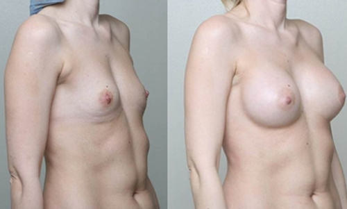 Before and After Image: Patient 2 - right-front-oblique