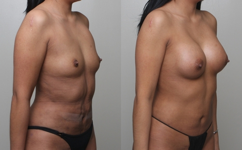 Before and After Image: Patient 3 - right-front-oblique