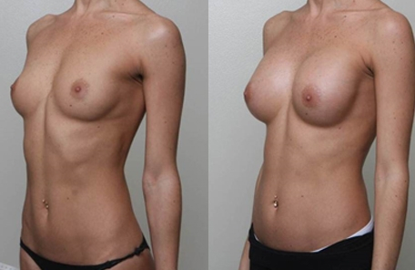 Before and After Image: Patient 4 - left-front-oblique