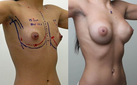 Before and After Image: Patient 5 - right-front-oblique