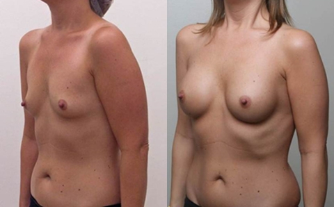 Before and After Image: Patient 6 - left-front-oblique