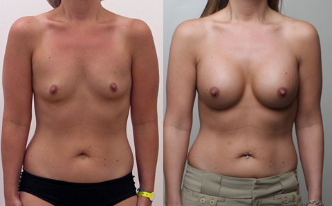 Before and After Image: Patient 7 - front