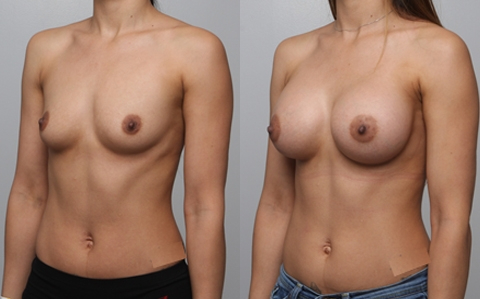 Before and After Image: Patient 8 - left-front-oblique