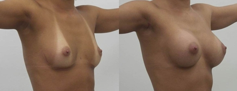 Before and After Image: Patient 9 - right-front-oblique