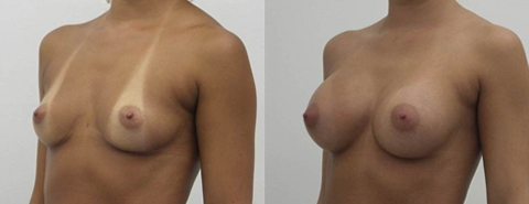 Before and After Image: Patient 9 - left-front-oblique