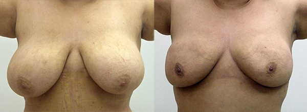Before and After Image: Patient 1 - front