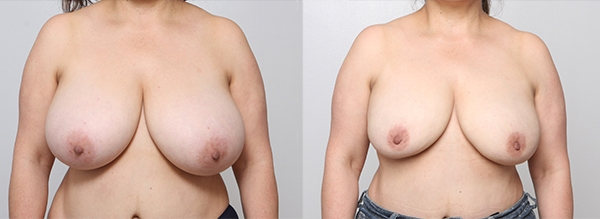 Before and After Image: Patient 2 - front