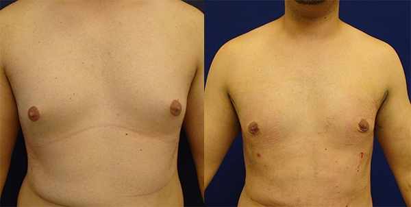 Before and After Image: Patient 1 - front