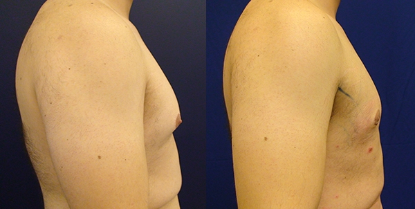 Before and After Image: Patient 1 - right-side