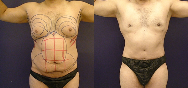 Before and After Image: Patient 2 - front