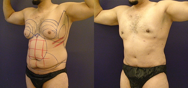 Before and After Image: Patient 2 - left-front-oblique