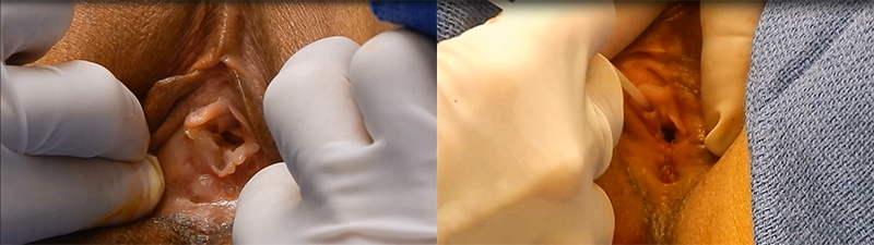 Before and After Image: Patient 1 - front