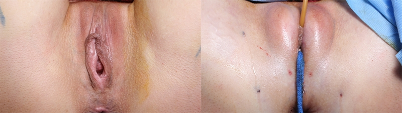 Before and After Image: Patient 1 - front