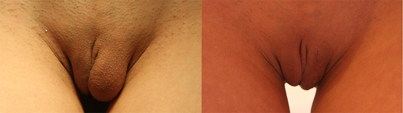 Before and After Image: Patient 2 - front
