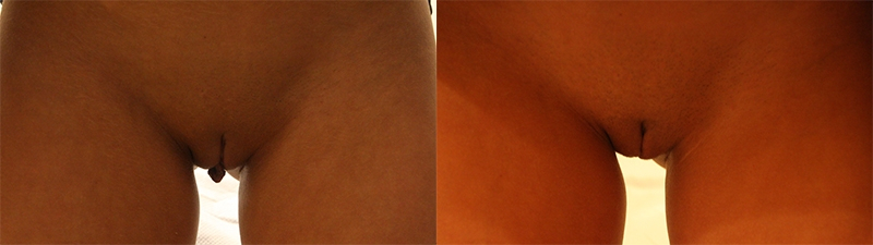 Before and After Image: Patient 1 - front