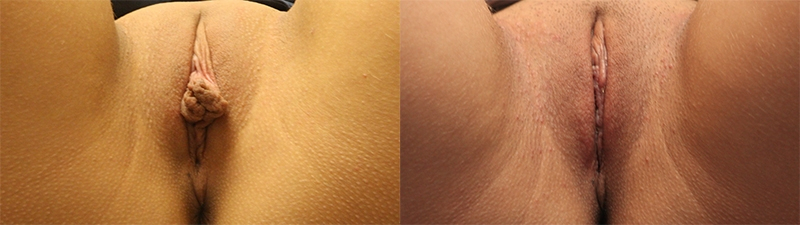 Before and After Image: Patient 2 - front