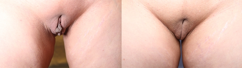 Before and After Image: Patient 3 - front