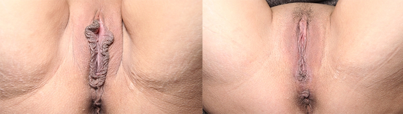 Before and After Image: Patient 4 - front