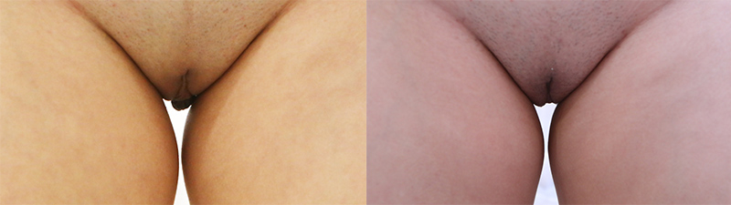 Before and After Image: Patient 5 - front