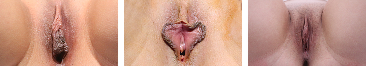 Before and After Image: Patient 7 - front