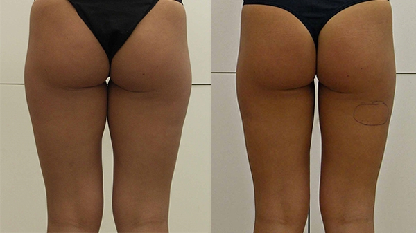 Before and After Image: Patient 1 - back