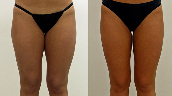 Before and After Image: Patient 1 - front