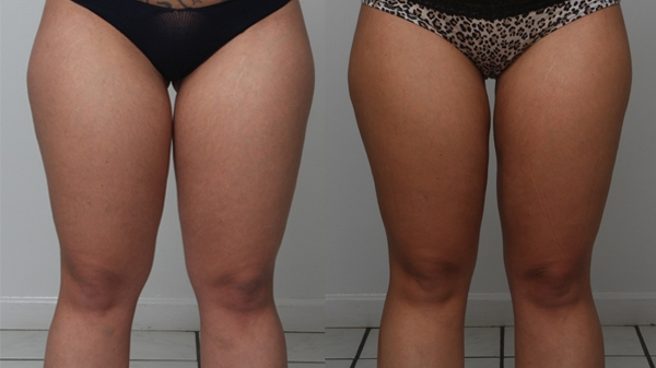 Before and After Image: Patient 2 - front
