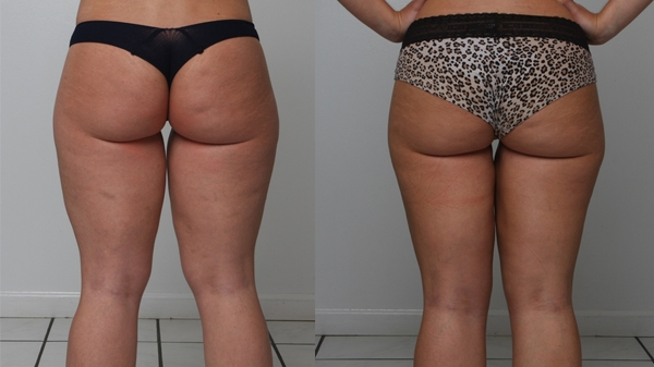 Before and After Image: Patient 2 - back