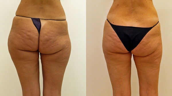 Before and After Image: Patient 3 - back
