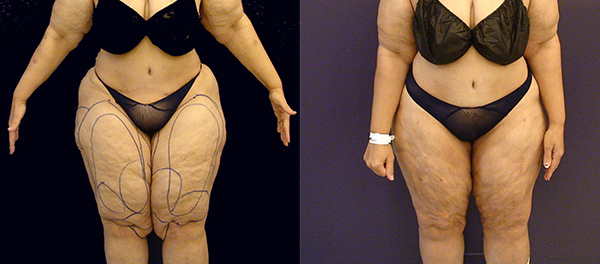 Before and After Image: Patient 4 - front