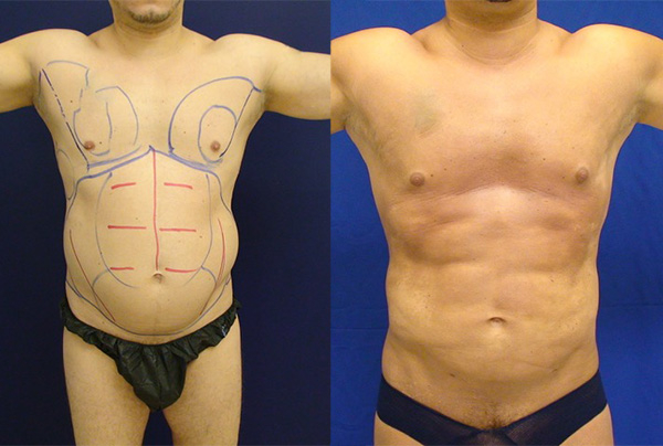 Before and After Image: Patient 1 - front