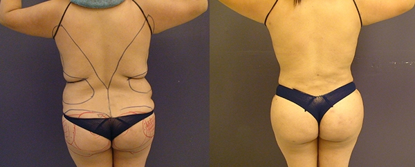 Before and After Image: Patient 1 - back